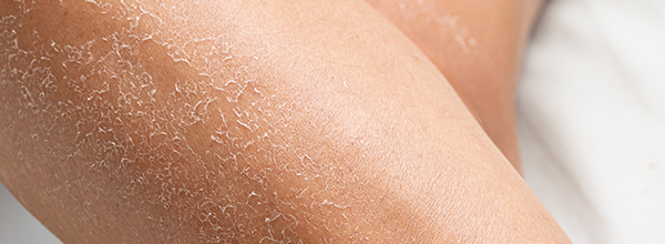 7 Penyebab Kulit Kering dan Cara Mengatasinya